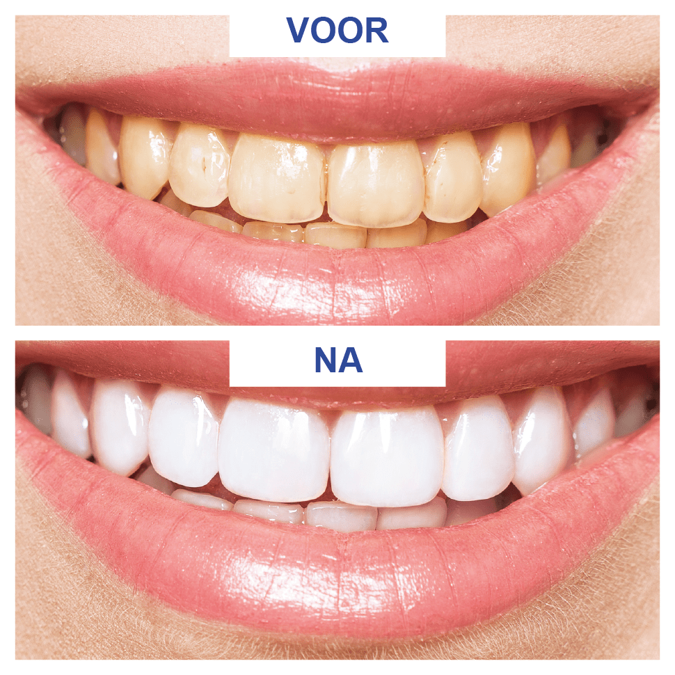 Whitening Strips Zijn Ze Echt Slecht Voor Je Tanden?