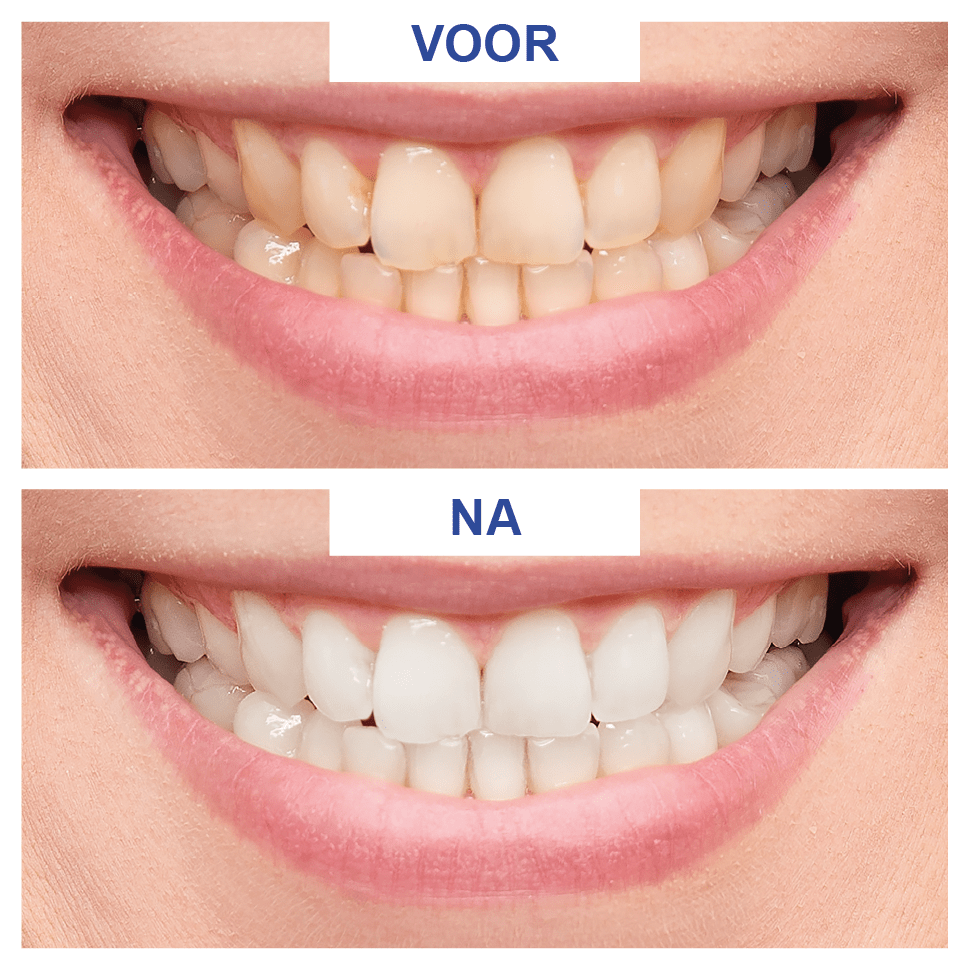 WitTand.nl Tandenbleek Producten Bestellen Zelf Tanden Bleken